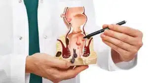 Hémorroides